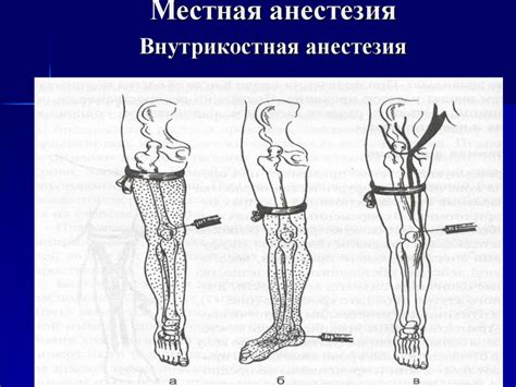 Местная анестезия - презентация онлайн