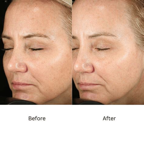 ZO® BRIGHTALIVE Skin Brightener - Advanced Dermatology and Cosmetic Surgery