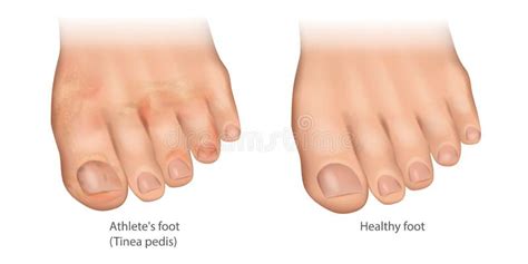 Illustration of the Athlete S Foot and Healthy Foot. Tinea Pedis or ...