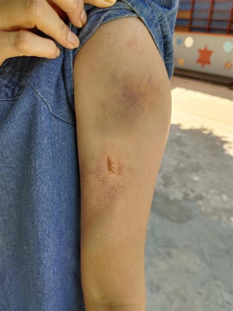 Brawl Erupts Among Hawkers At Penang, Leaves Woman Bruised & Bleeding