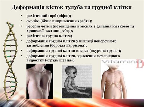 Гіповітаміноз. Рахіт. Гіпервітаміноз вітаміну Д. Гіпокальціємічний ...