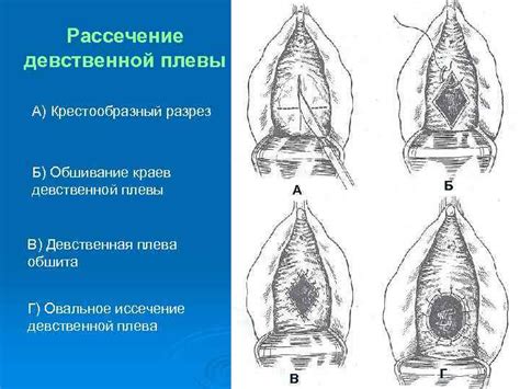 Девственная плева - как выглядит, где находится, виды и фото