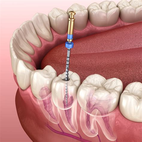 Root Canal Procedure: What to Expect and How It Can Save Your Tooth