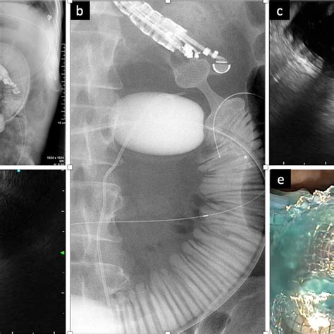 Lumen-apposing metal stent (Axios, Boston Scientific, Marlborough,... | Download Scientific Diagram