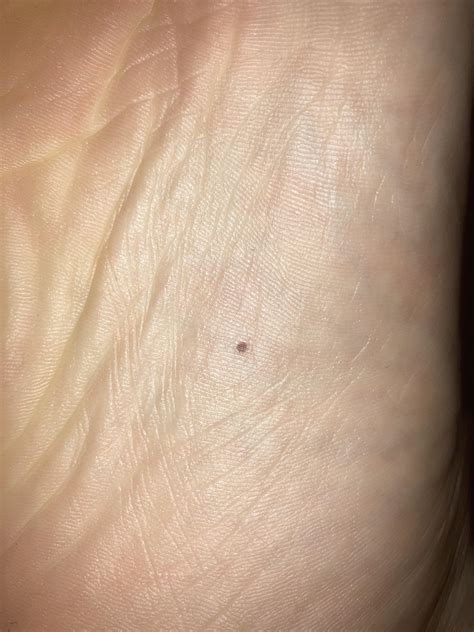 Is this skin cancer? on the bottom of foot : r/DermatologyQuestions