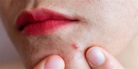 Nodular Acne: Symptoms, Causes, and How To Treat It