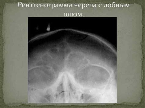Лобный шов и дополнительные кости швов Выполнил студент