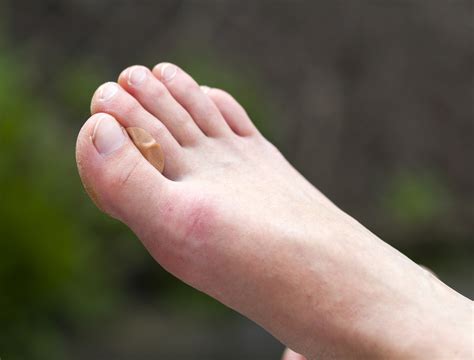Брадавици: видове и лечение | DR—DENKOVA DERMATOLOGY
