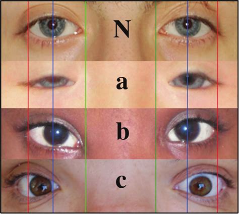 red lines   lateral canthus blue lines   pupils  green