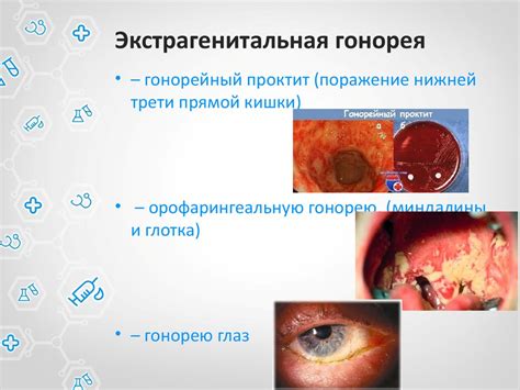Гонорея - презентация онлайн