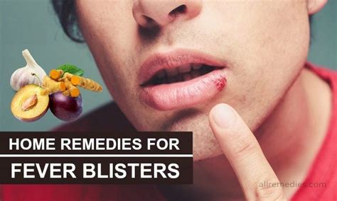 29 Natural Home Remedies for Fever Blisters in Adults