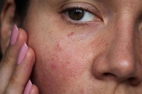 how to fix broken capillaries on the face