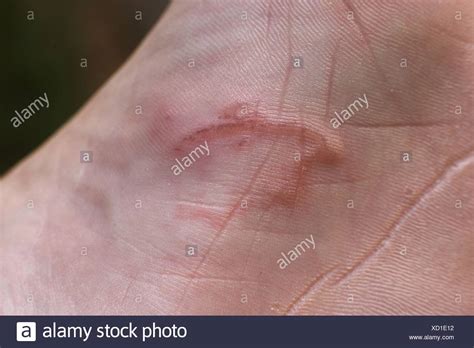 Hookworm Rash In Humans