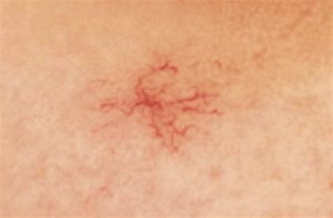 What is Spider Naevus and How to Treat it? - Luxe Hair & Skin Clinic