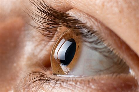 Eye Care Series: Symptoms of Keratoconus – LASIK Denver | Cataract Surgery