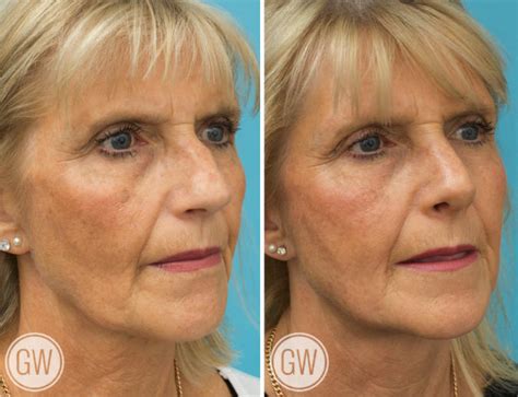 dr guy watts plastic surgeon perth gallery rhinoplasty