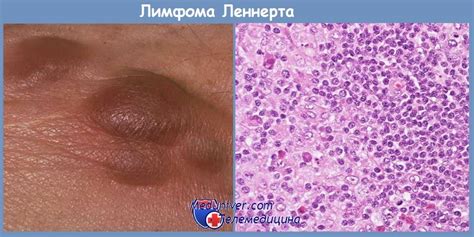 Дифференциальная диагностика лимфосаркомы