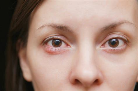 Stye Symptoms, Causes & Treatment [Definitive Guide]