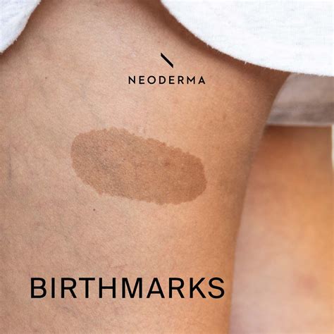 brown birthmark