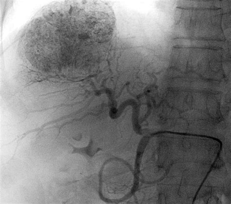 TACE Versus Radioablation in the Treatment of Hepatocellular Carcinoma ...