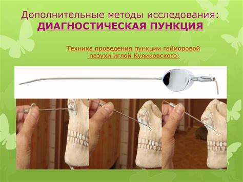 Одонтогенные верхнечелюстные синуситы - презентация онлайн