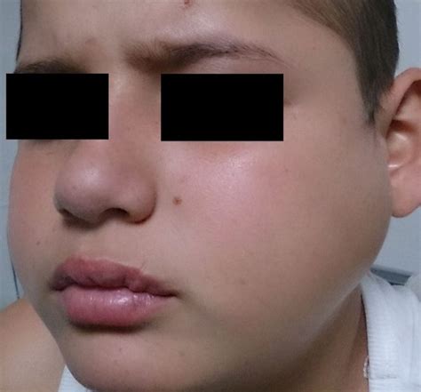 Mumps | Cause, Symptoms, Signs, Management | Geeky Medics