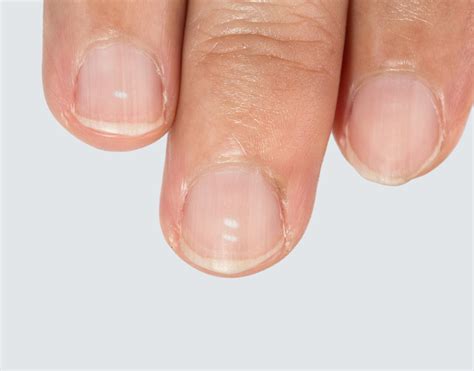 White spots on fingernails