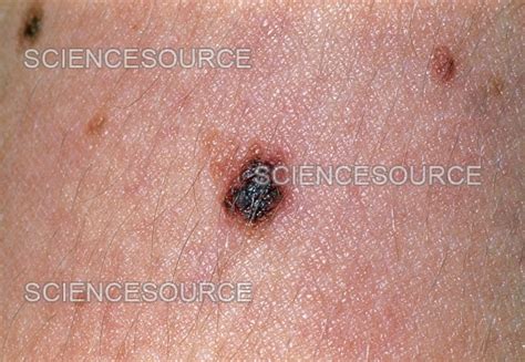 benign mole