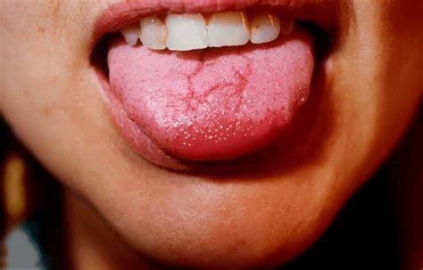 Decoding Tongue Bumps: Uncover the Truth – 7 Vital Tips