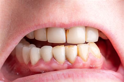 tooth cavity images eremedium