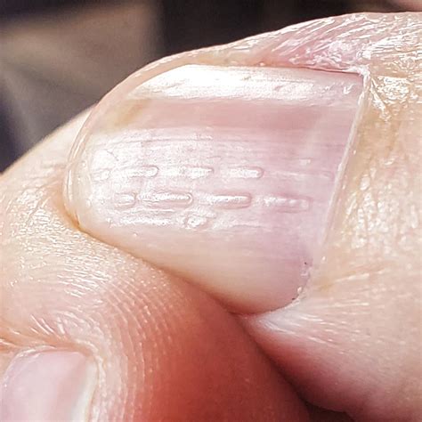 Do Ridges In Fingernails Indicate Anything at Barbara Newton blog