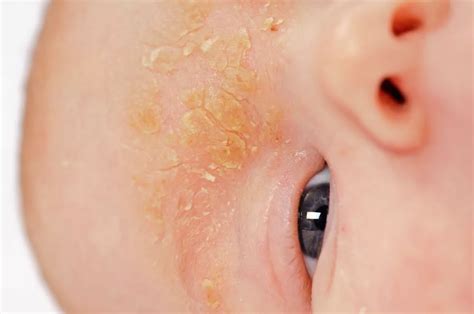 Symptoms of Seborrheic Dermatitis - Dr. Eddie's Happy Cappy