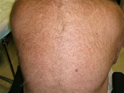 Dermatofibroma - Stock Image - C056/2507 - Science Photo Library