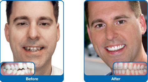 Damon Braces Before and After - Bahamas Orthodontic Center | Nassau ...