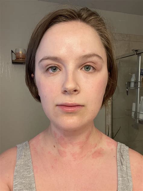 Woke up puffy as all get out : r/urticaria