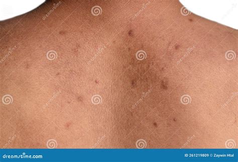 black spots  scars    stock image image  acnes natural
