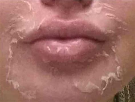 Шелушение и покраснение кожи на лице: ТОП методов лечения