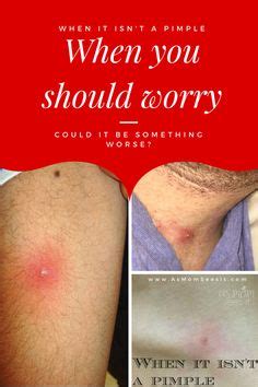 Natural Treatment for Cellulitis using with Herbal Properties ...