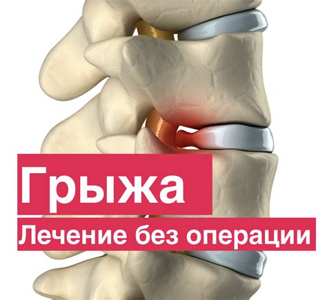 Грыжа позвоночника. Лечение
