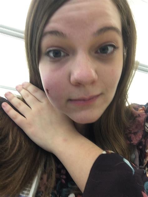 Staph On Cheek