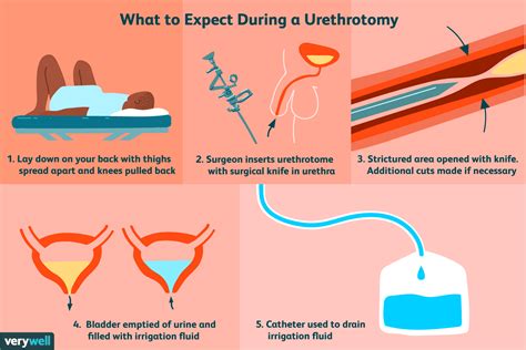 Urethrotomy: Uses, Side Effects, Procedure, and Results