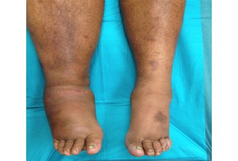 Type 2 Diabetes Leg Swelling - ScienceHUB