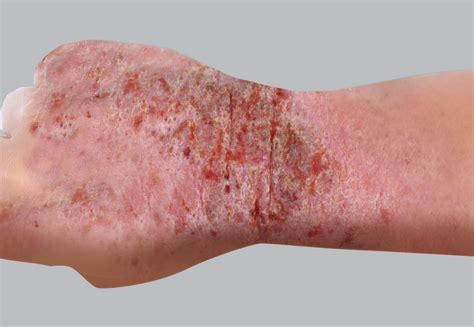 Eczema And Atopic Dermatitis Rashes Causes Symptoms