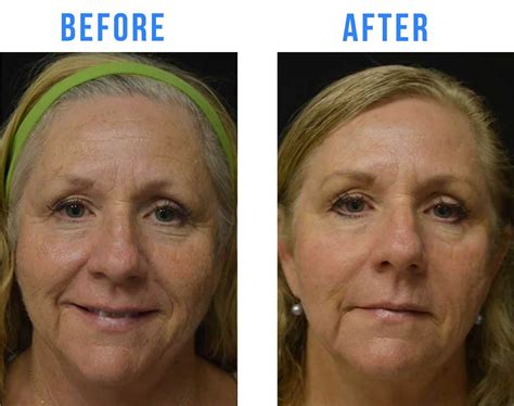 Sunspots On Face Treatment