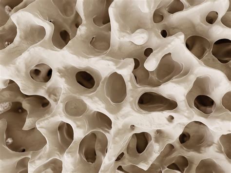 The Secret Protein Sabotaging Bone Health and What It Means for