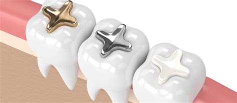 Metal Free Fillings In Porter, TX 77365 - Porter Smiles Dental