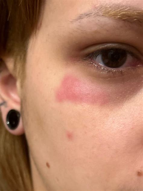 Itchy rash on face : r/DermatologyQuestions