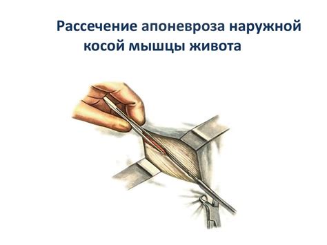 Хирургическая тактика при остром аппендиците. Техника аппендэктомии ...