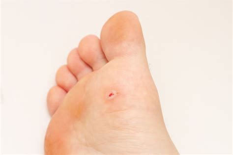 foot corn symptoms   recognize  treat corns   feet