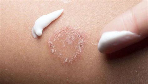 Ringworm: What Is Ringworm?